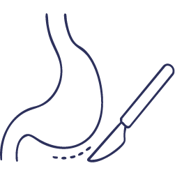 جراحة المرارة